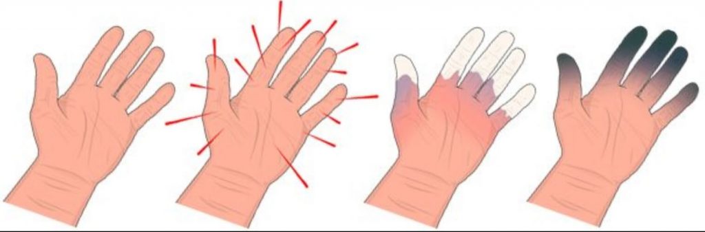Hand-Arm Vibration