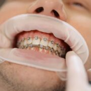 The Ultimate Guide to Orthodontic Treatments: What You Need to Know