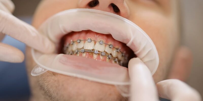 The Ultimate Guide to Orthodontic Treatments: What You Need to Know