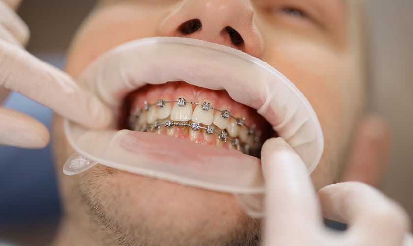 The Ultimate Guide to Orthodontic Treatments What You Need to Know